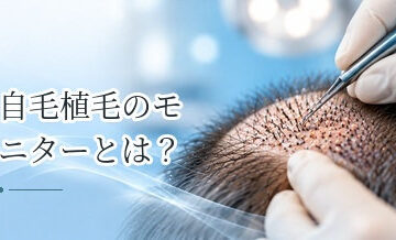 自毛植毛のモニターとは？割引条件・写真掲載など確認したいポイント