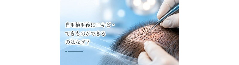 自毛植毛後にニキビ・できものができるのはなぜ？毛嚢炎の注意点