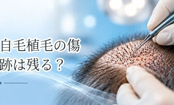 自毛植毛の傷跡は残る？FUE・FUTで異なる傷の特徴