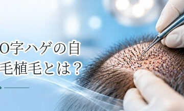 O字ハゲの自毛植毛とは？頭頂部の植毛で知っておきたいこと