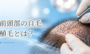 前頭部の自毛植毛とは？生え際から前頭部をカバーする方法