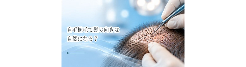 自毛植毛で髪の向きは自然になる？毛流を考えた移植の重要性