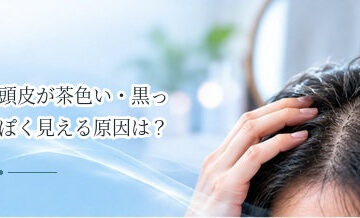 頭皮が茶色い・黒っぽく見える原因は？日焼け・色素沈着などを確認