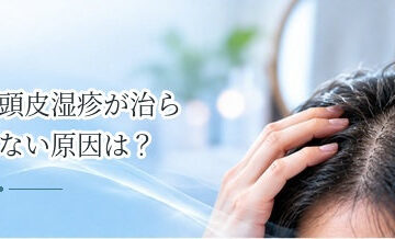頭皮湿疹が治らない原因は？セルフケアと皮膚科受診の目安